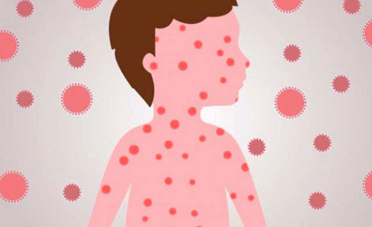 Las enfermedades que resucitaron – Movimiento antivacunas